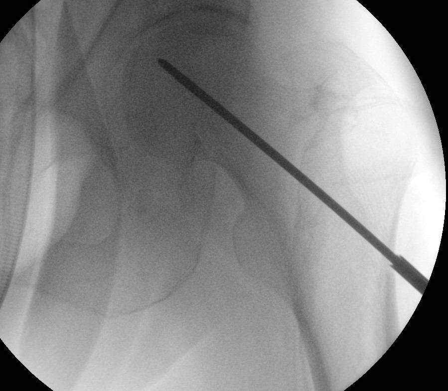 Hip Forage Intraoperative